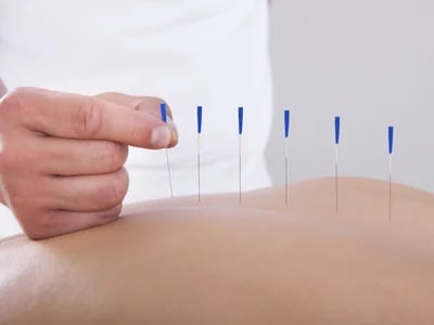 Akupunktura és az emésztőrendszer egészsége – Akupunkturbehandlungen usw magyarázata